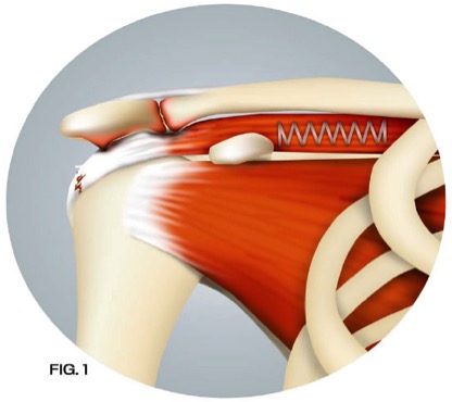 Illustration 1 of Arthroscopy for repairing a rotator cuff injury. JOI Rehab