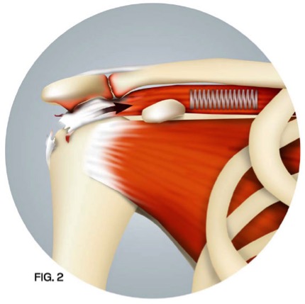 Illustration 2 of Arthroscopy for repairing a rotator cuff injury. JOI Rehab