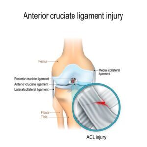 Anatomical diagram of an ACL tear with labels on the anatomy