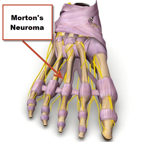Nerve Problems of the Foot - JOI Jacksonville Orthopaedic Institute