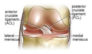 Meniscal Tear Types. There are four types of meniscal tears.