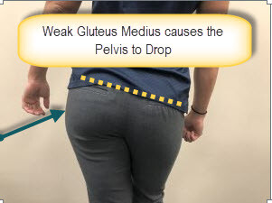 weakness in the Gluteus medius can lead to knee pain and back problems. The gluteus medius helps to keep the pelvis level with standing on one leg during walking.