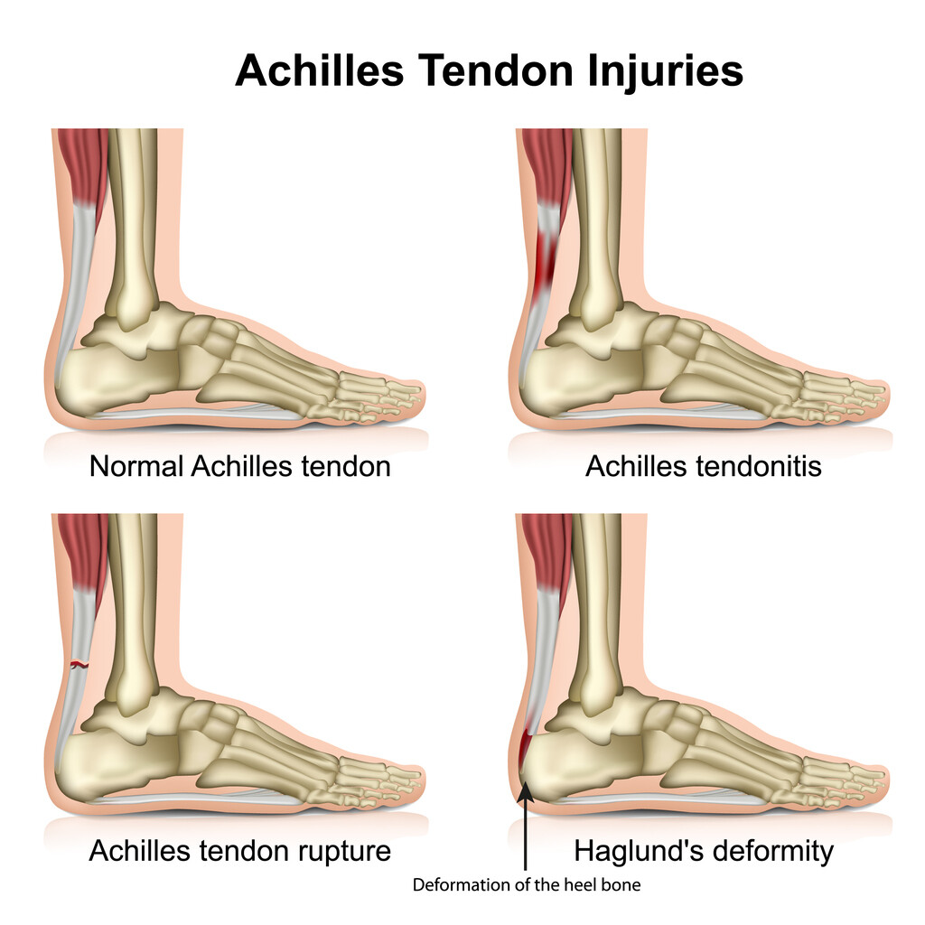 Where Is Achilles Tendon Located