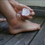 image of icing swollen injured ankle