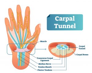 Carpal tunnel syndrome is a common injury treated by orthopedic surgeons.