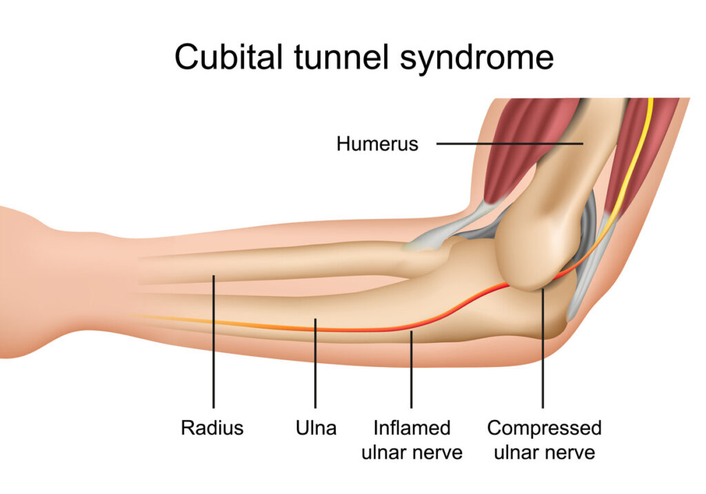 Cubital tunnel syndrome