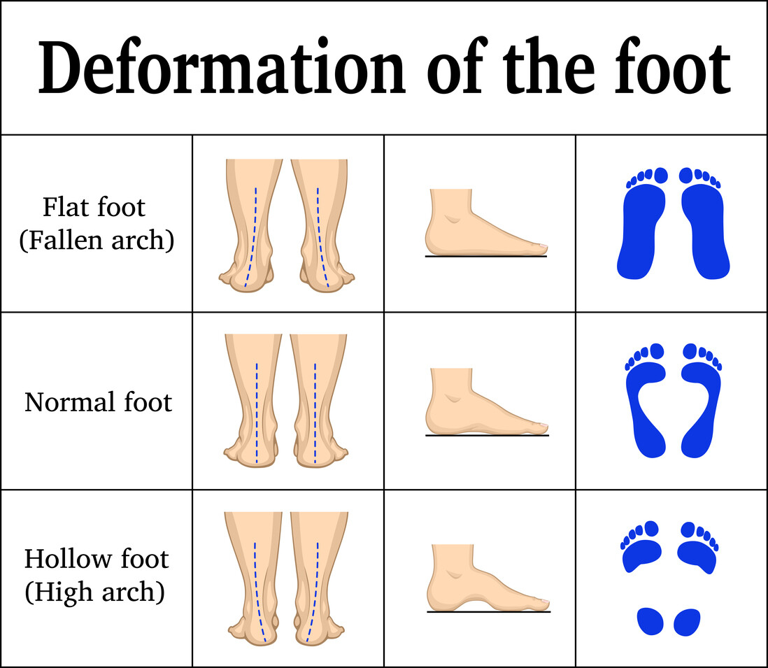 Adult Flat Foot Deformity JOI Jacksonville Orthopaedic Institute