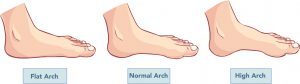 Flat Feet and Normal Arches
