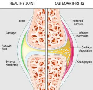 Anatomical image of a joint that is healthy on the left and has osteoarthritis on the right with cartilage degeneration in the synovial fluid