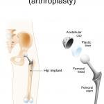 A hip replacement or hip arthroplasty is necessary with some people with severe arthritis.