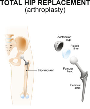 A hip replacement or arthroplasty is necessary with some people with severe arthritis