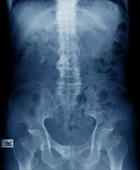 Ankylosing Spondylitis can be treated with medications, physical therapy, exercise, and in extreme cases, surgery.