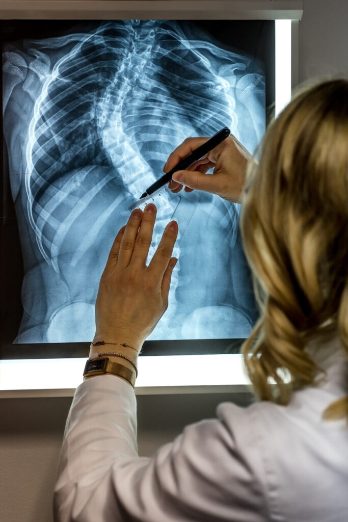 Scoliosis X-ray
