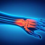Wrist Fracture FAQ