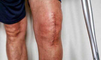 Image of a post op total knee replacement