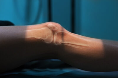 Shot of process x-ray, knee close-up.