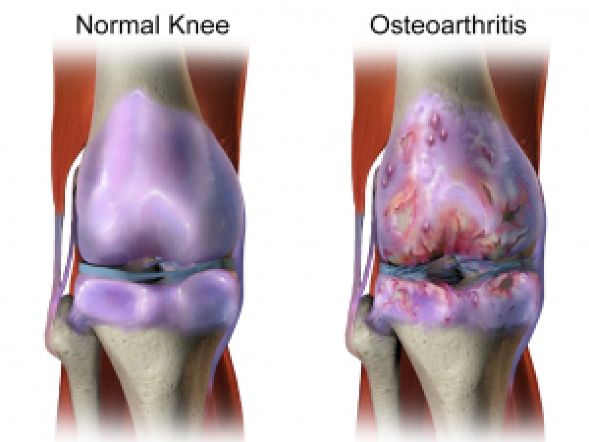 osteoarthritis)
