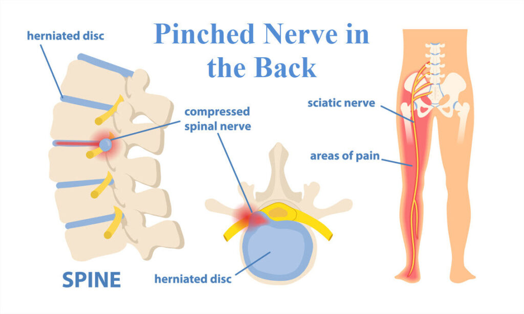 Pinched Nerve of the Back - Jacksonville Orthopaedic Institute