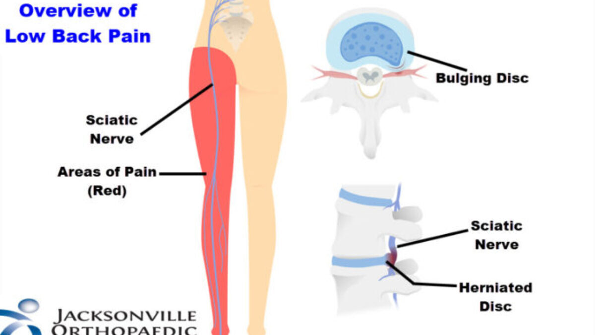 Sciatica: Overview of Low Back Pain - JOI and JOI Rehab