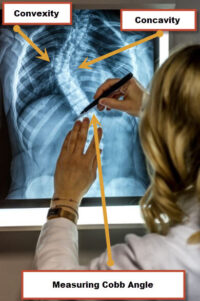 physician measuring cobb angle for scoliosis with labeled concavity and convexity curves
