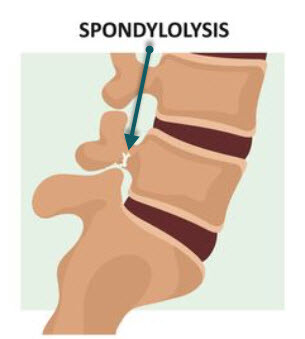 Image and label of spondylolysis and pars interarticularisstress fracture