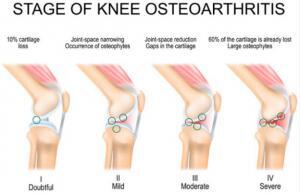 Image of the 4 stages of osteoarthritis in the knee