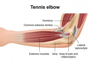 illustration of anatomy of tennis elbow showing muscles and tendons involved