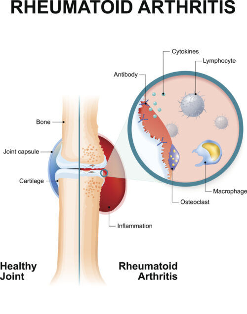 Rheumatoid Arthritis