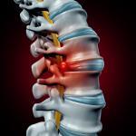 A herniated disc can cause tingling in the fingers.