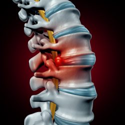 Herniated discs
