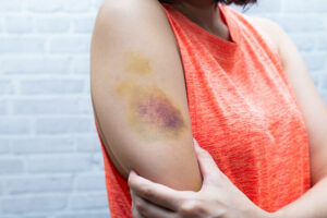 Arm with Hematoma