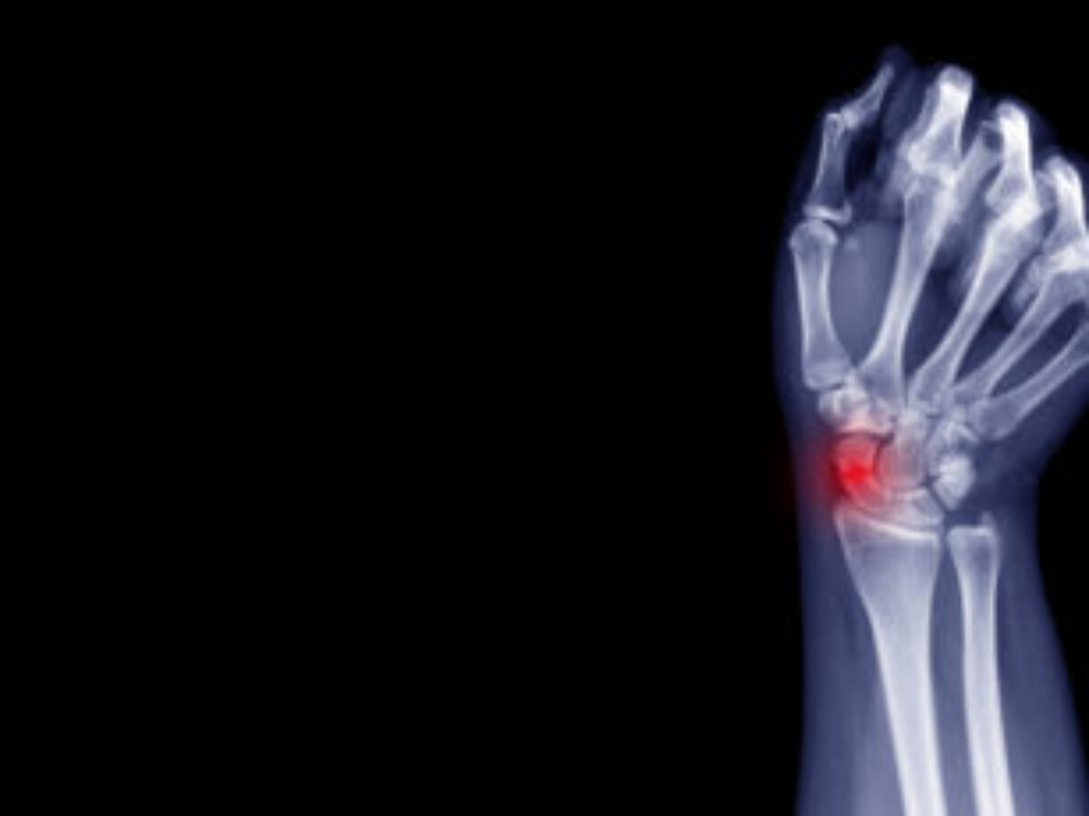 Ulna Hairline Fracture