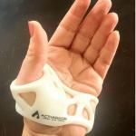 image of ActivArmor push splint to stabilize the basal joint of the thumb
