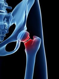 broken hip