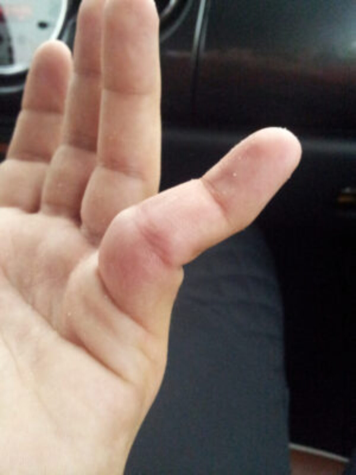 How to treat a purple swollen finger - Quora