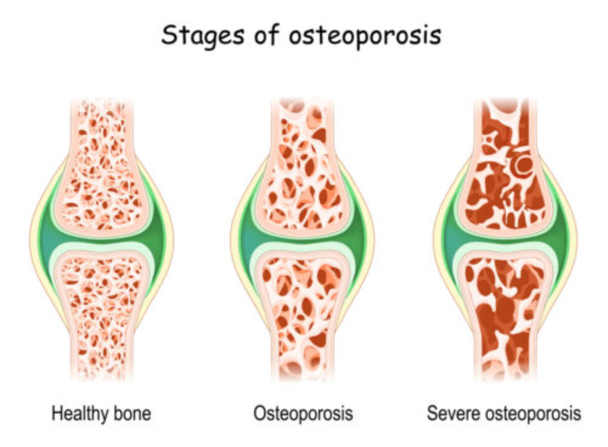 Osteoporosis - JOI Jacksonville Orthopaedic Institute