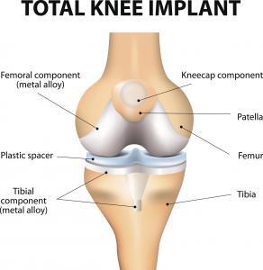 A total knee arthroplasty has several major components.