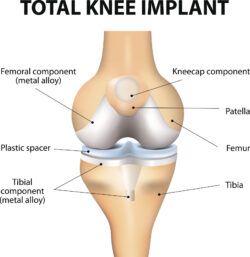 There are several components to a knee arthroplasty or replacement