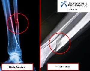X-Ray of a broken Tibia and fibula fractures showing a Tibia fracture on the right and fractured Fibula on the left. JOI Rehab