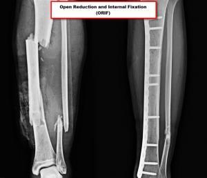 X-Ray of a fractured Fibula and Tibia and a repaired Fibula and Tibia through Open Reduction and Internal Fixation (ORIF). JOI Rehab