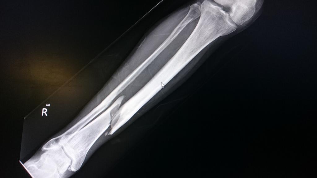 Tibia and Fibula Fractures JOI Jacksonville Orthopaedic Institute