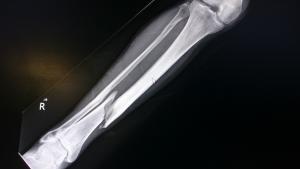 X-ray Image of a fracture in a tibia