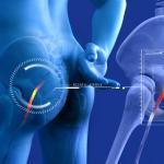 An overview of sciatica