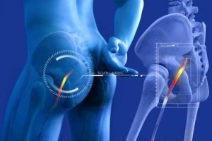 What causes sciatic nerve pain