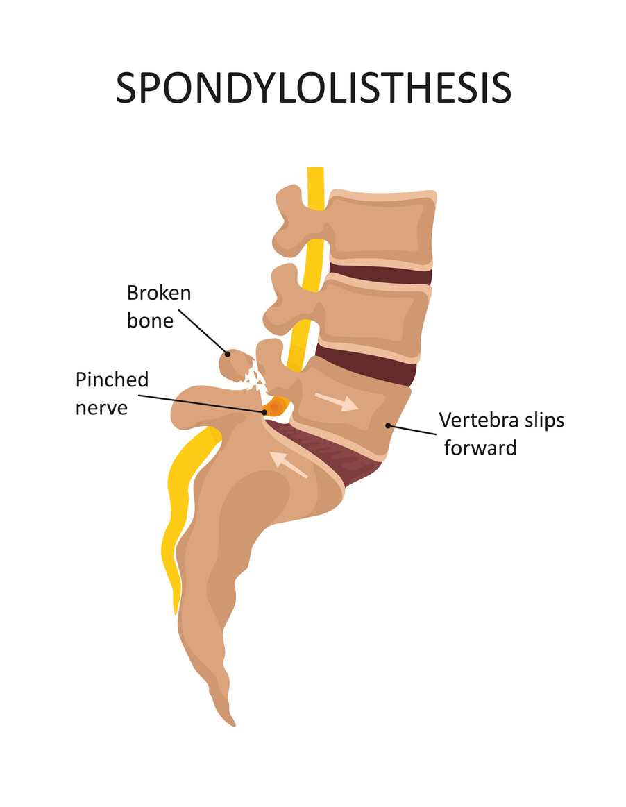 What is Spondylolisthesis? JOI Jacksonville Orthopaedic Institute