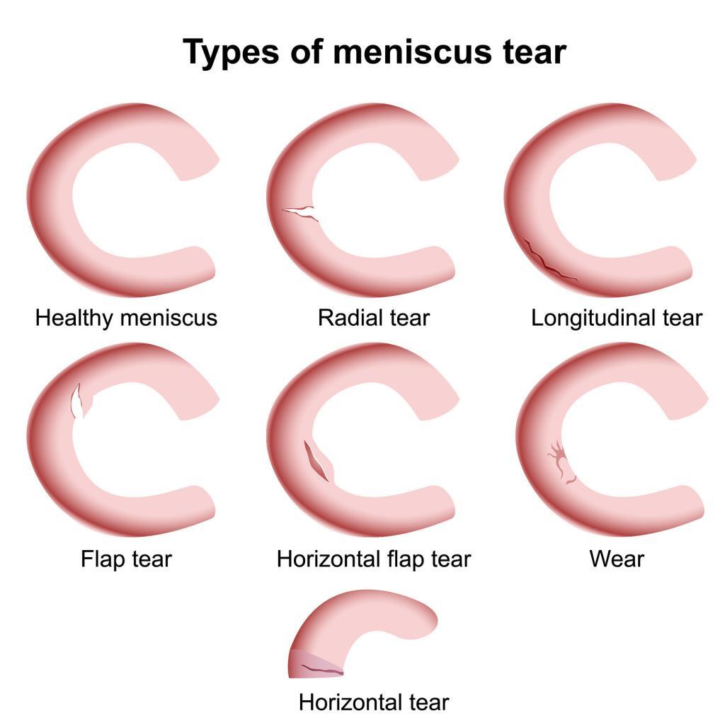 Diagram of the different types of tears that can occur to the Menisci. JOI Rehab