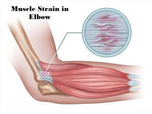 Zoomed in image of the muscles and tendons in elbow. This is a common place for a muscle strain to occur also referred to as tennis elbow. JOI Rehab