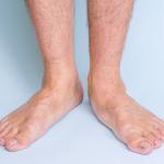 image of pes planus also known as flat feet