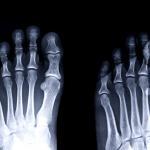 Morton’s Toe is an orthopedic condition that may need treatment.