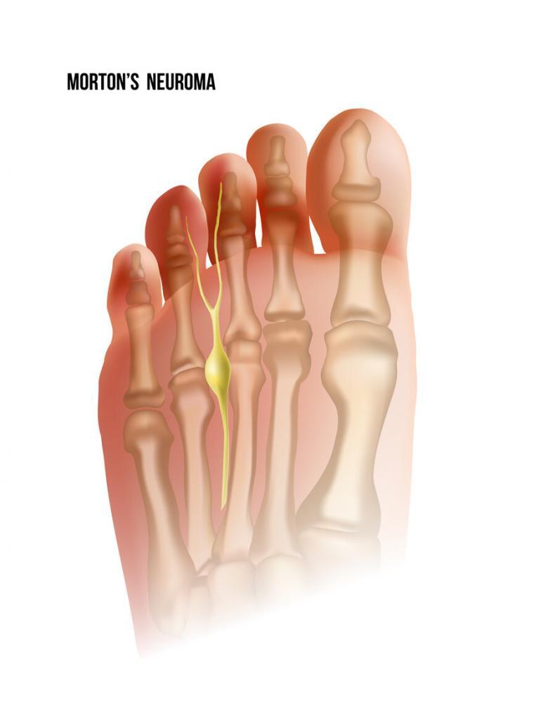 Understanding Morton's Toe - JOI Jacksonville Orthopaedic Institute